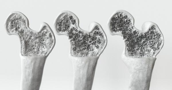 Bone Health and Osteoporosis: An Orthomolecular Perspective