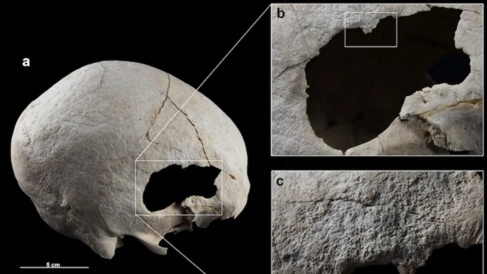 Copper Age woman survived two skull surgeries up to 4500 years ago