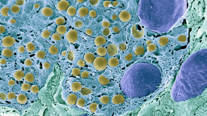 In a first, scientists reversed type 1 diabetes by reprogramming a person's own fat cells