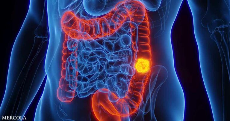 What You Eat May Affect Colon Cancer Outcomes, Researchers Say