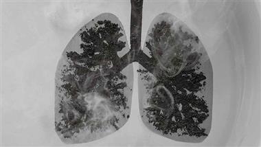 Lung Cancer in Non-Smokers Is on the Rise: Experts Explain Why
